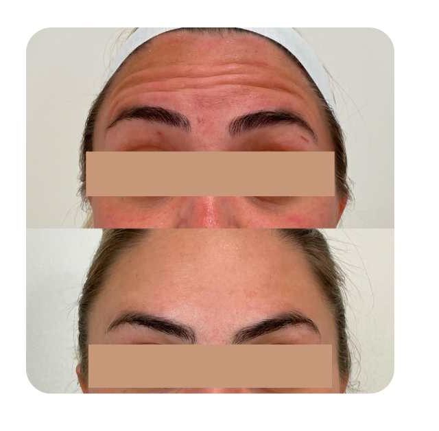 1 Botox 1 Botox
