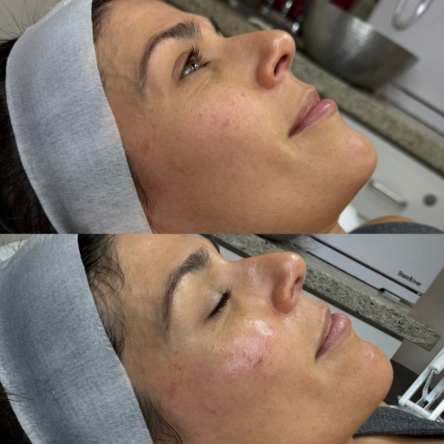 1 Hydrafacial 1 Hydrafacial