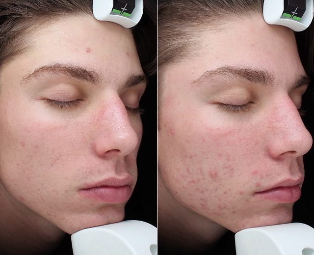1 VI PEEL