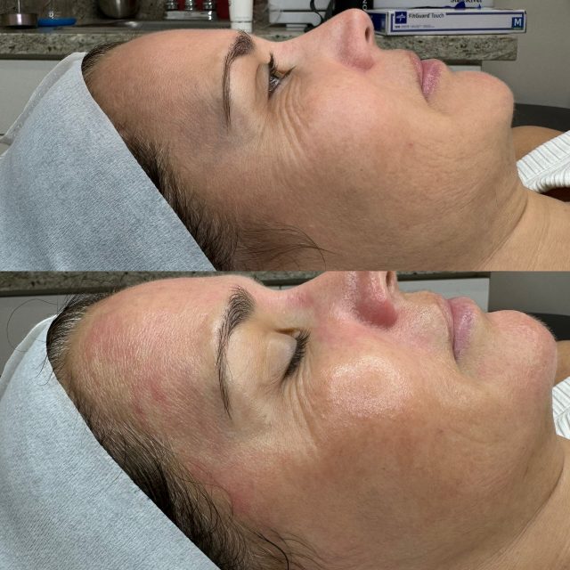2 Hydrafacial 2 Hydrafacial