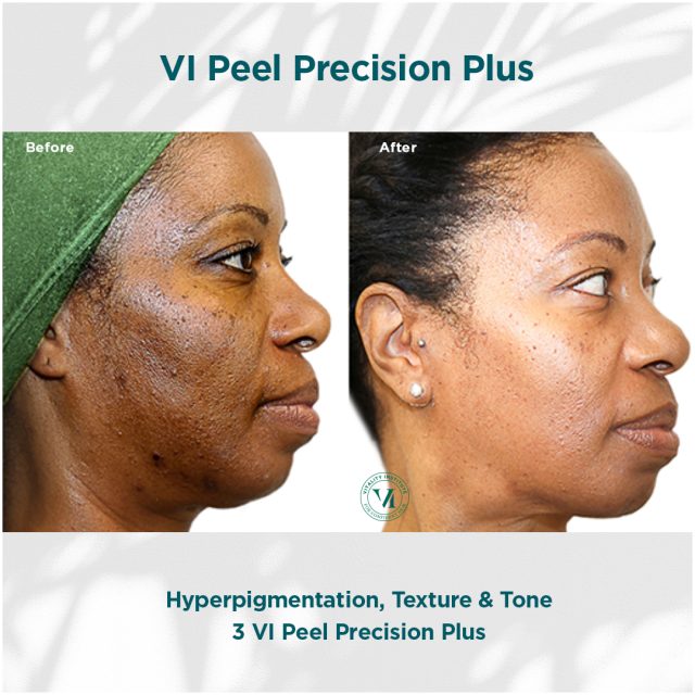 2 VI PEEL