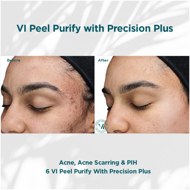 3 VI PEEL 3