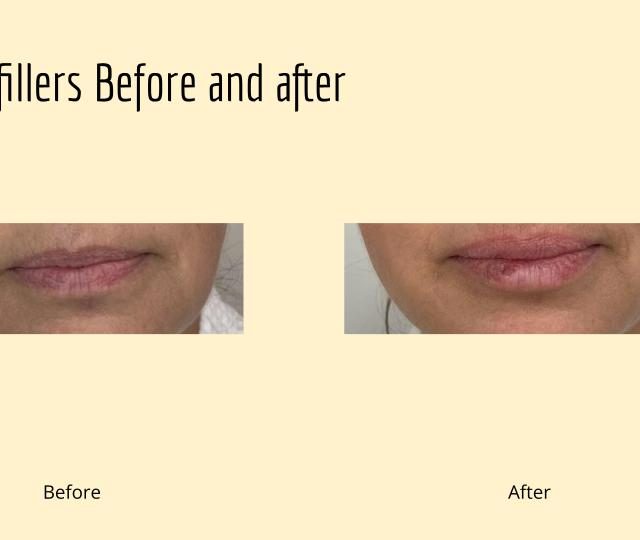 Restylane Restylane